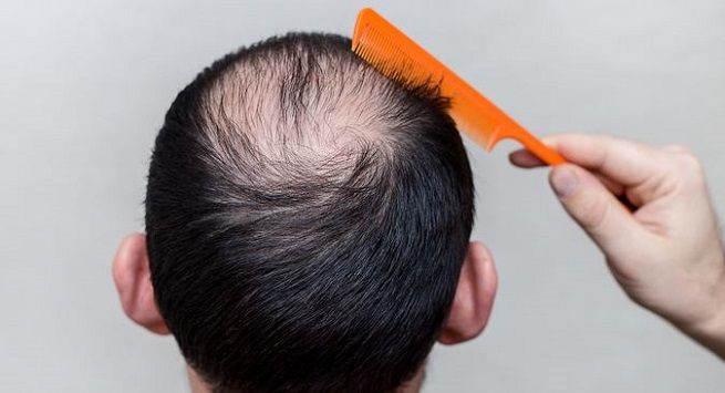 Rụng tóc nhiều có nguy cơ gây hói đầu