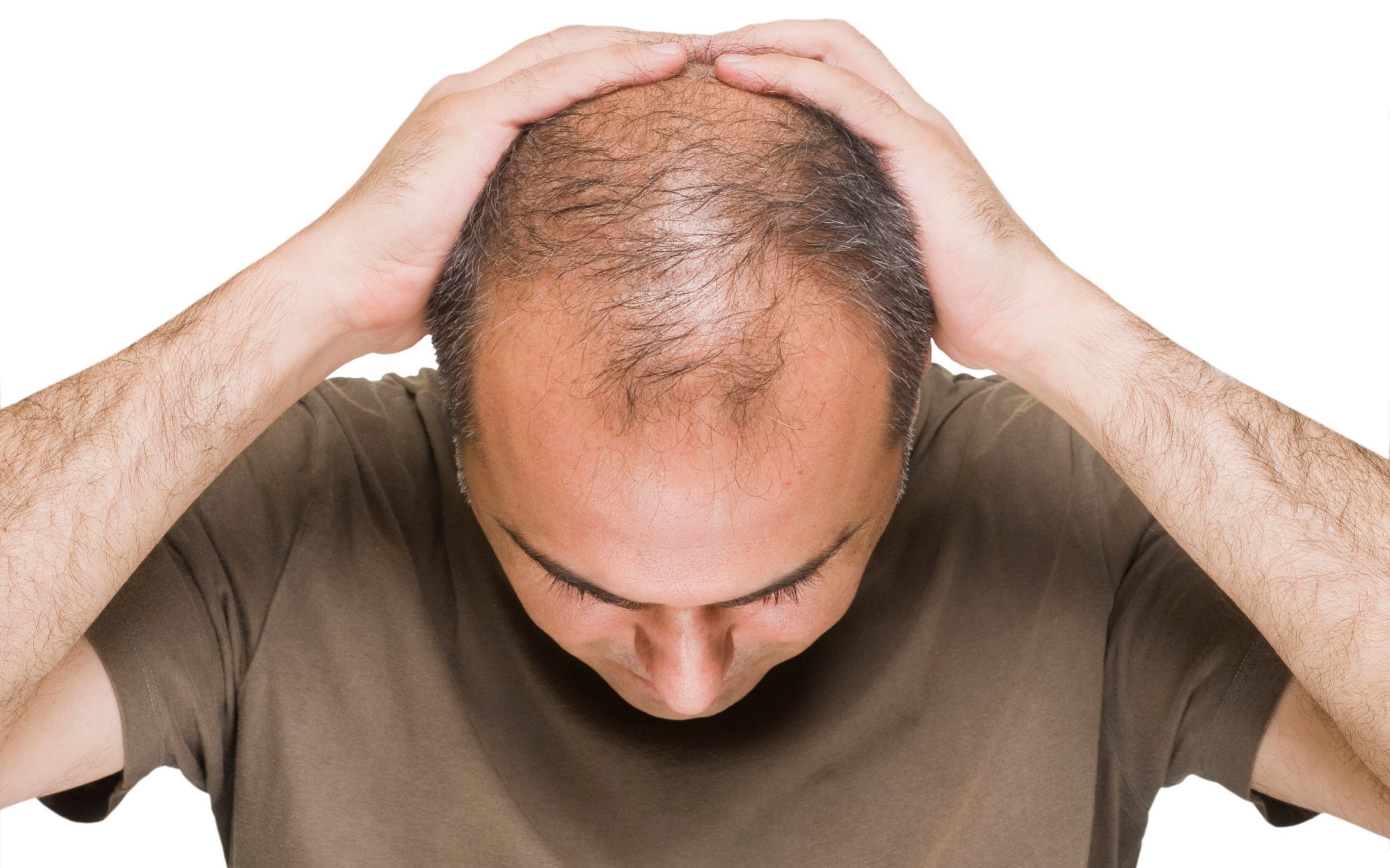 Rụng tóc nhiều kéo dài có thể gây hói đầu